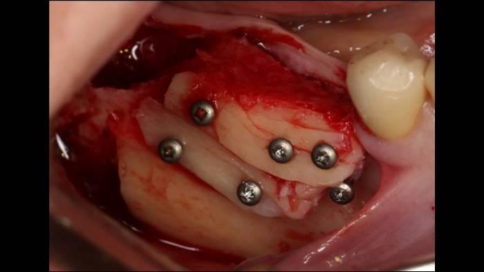 Устранение концевого дефекта нижней челюсти с использованием аутогенного костного блока