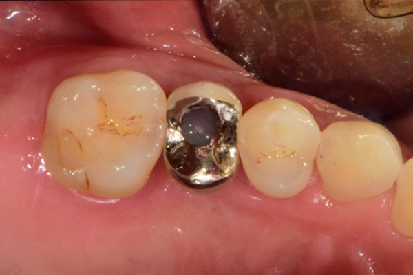 Отсроченная имплантация и методика консервации лунки для минимизации утраты кости после удаления зуба