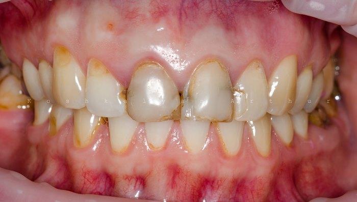 Эстетическая реабилитация фронтальной группы зубов