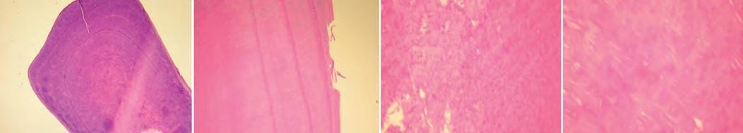 Фото 6: Микроскопическое исследование тканей зуба (a) иррегулярный неравномерный дентиногенез (b) расслоение дентина (с) дентиногенез с глобулярными участками (d) интерглобулярный участок.