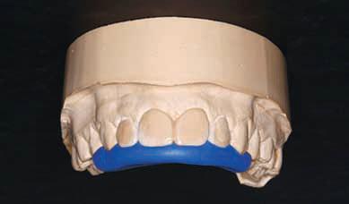 Метод лечение фронтальных зубов