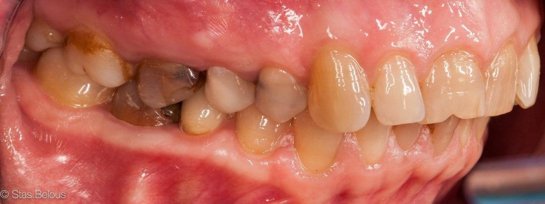 Установка цельнокерамических коронок на утраченные зубы