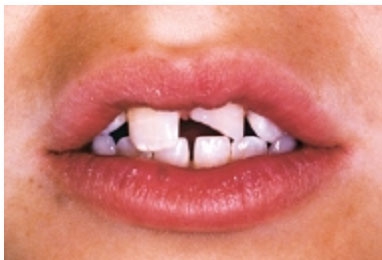 Лечение сколов молочных зубов