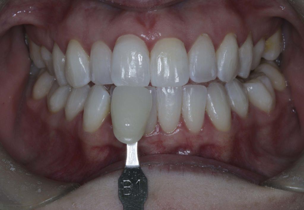 Лечение дисколорита одного зуба