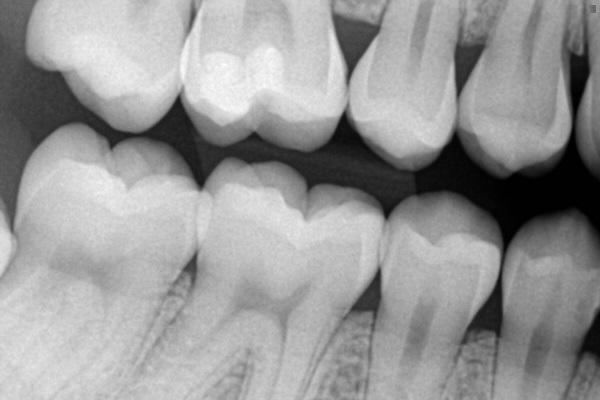 Эффективность внутриротовой рентгенографии в технике байтвинг для диагностики кариеса молочных зубов