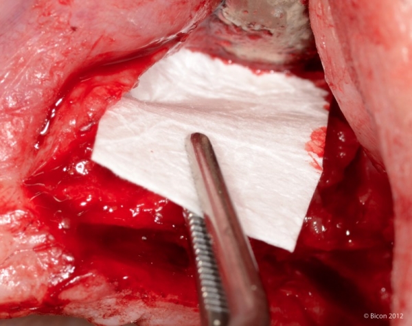 Поверх импланта и кости размещается рассасывающаяся коллагеновая мембрана Bicon.