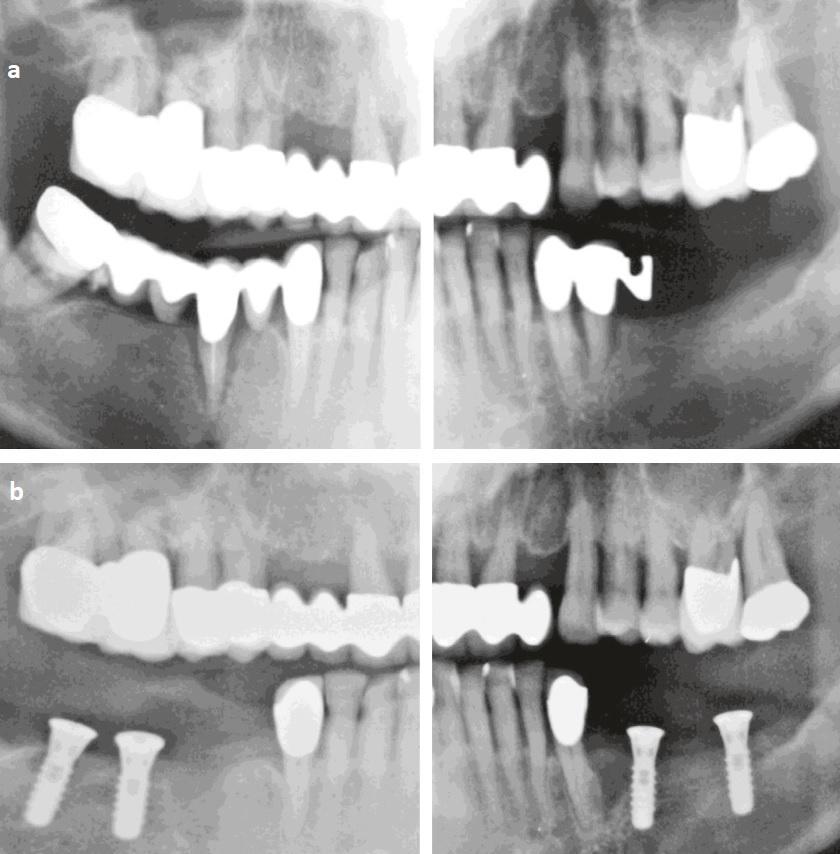 Деструкция костной ткани зуба лечение thumbnail