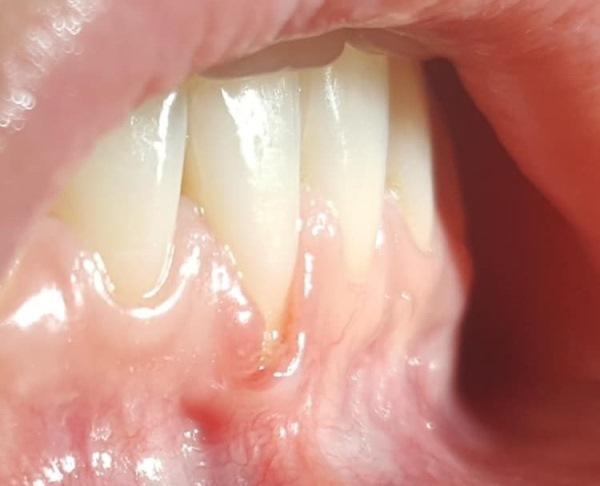 Вестибулопластика как профилактика множественных рецессий после ортодонтического лечения
