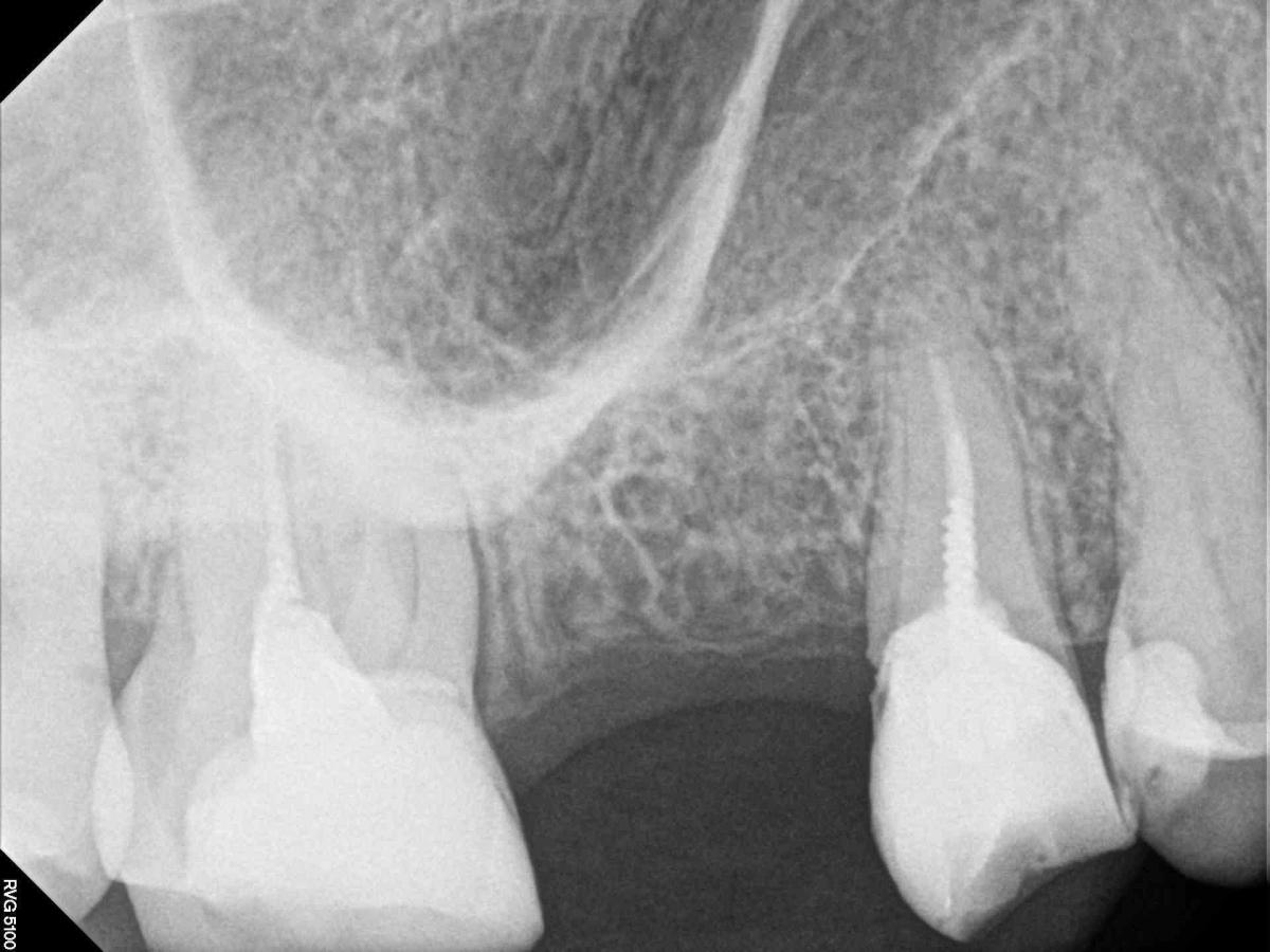 Удаление зуба с кистой в гайморовой пазухе