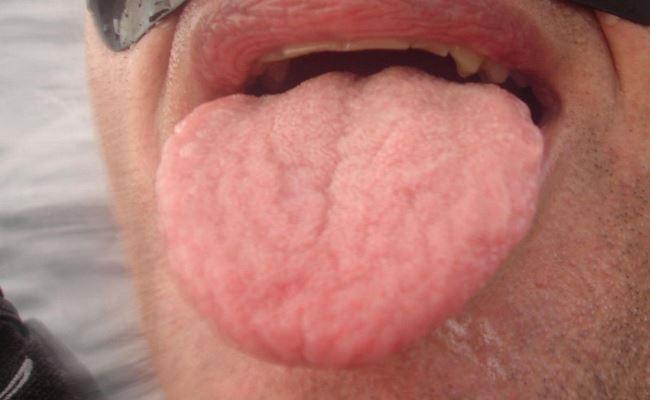 Что такое аллергический язык
