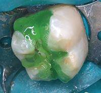 Изолирующая прокладка при лечении зуба thumbnail