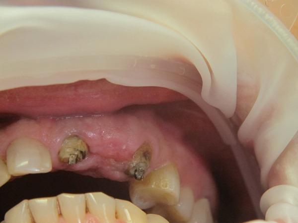 Методы восстановления коронковой части зубов с помощью современных материалов в одно посещение