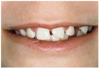 Скол на молочных зубах лечение