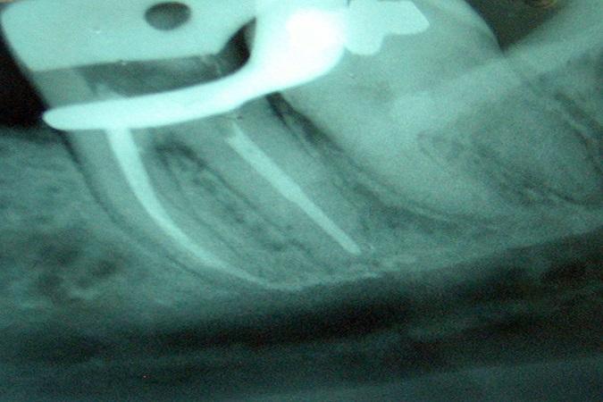 Парестезия нижней губы после лечения зуба