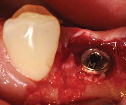 Эндоскопическое извлечение сверхкомплектного премоляра на нижней челюсти в процессе постановки имплантата