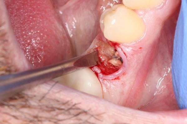 Выбор техники и материала для реконструкции лунки зуба