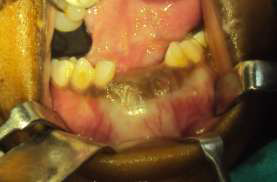 На интраоперационной фотографии образование захватывает зубные зачатки 41 и 42 зубов.