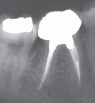 Перелом инструмента в корневом канале зуба