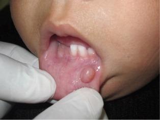Необычное мукоцеле полости рта у ребенка