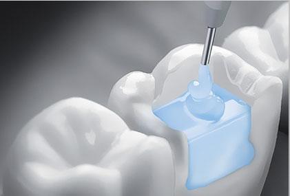 Разработан новый материал, позволяющий быстрее проводить процедуры по реставрации зуба