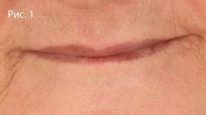 Тотальная имплантологическая реабилитация с помощью OneGuide