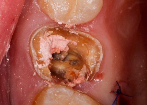 Одномоментная имплантация в область 26 зуба с закрытым синус-лифтингом