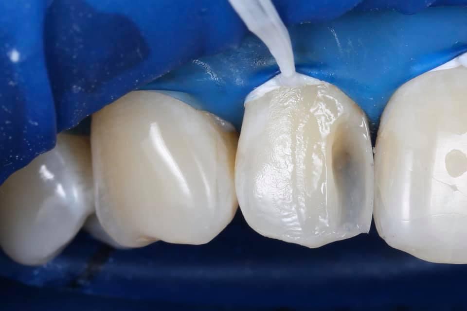 Зубная реставрация. Художественное восстановление зубов. Композиты для передних зубов. Восстановление композитом зубов. Восстановление передних зубов композитным материалом.