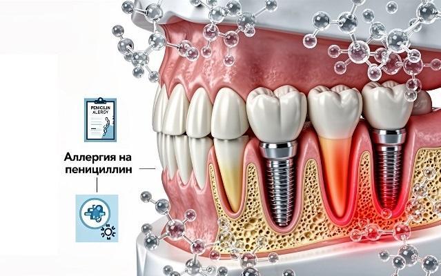 Аллергия на пенициллин и результаты дентальной имплантации (обзор)
