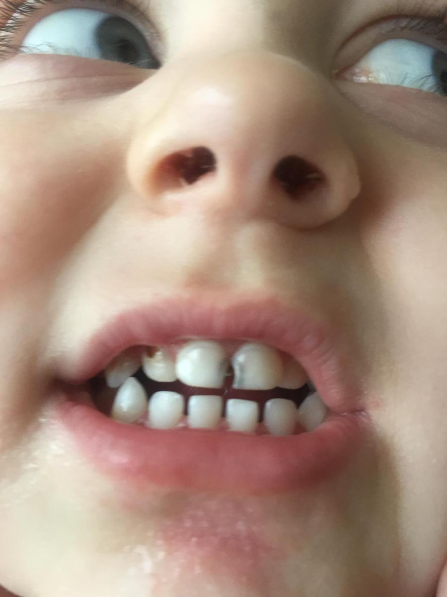 Болезни зубов у детей: симптомы распространенных недугов