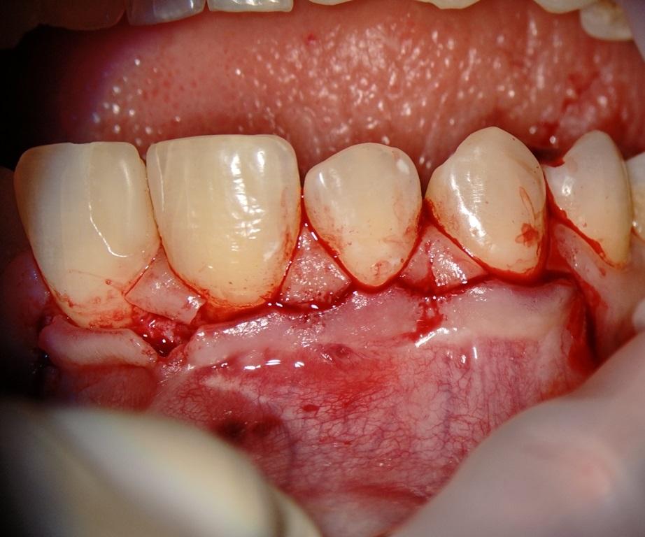 Сохранение зуба при деструктивных формах периодонтита (киста или гранулема)