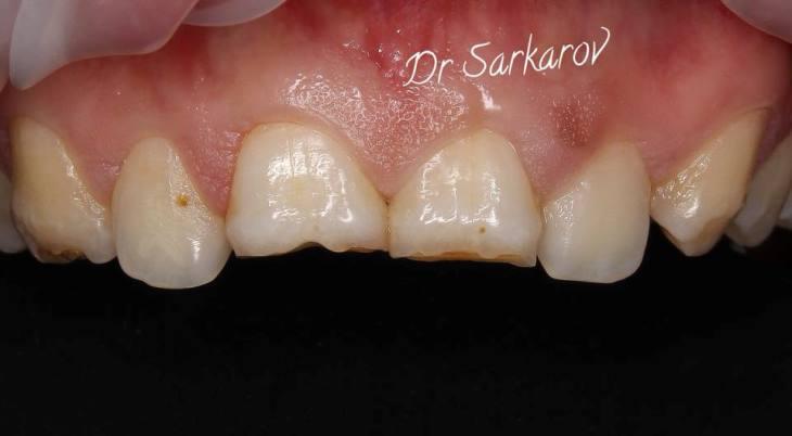 Реставрация 11, 21 зуба при гипоплазии эмали
