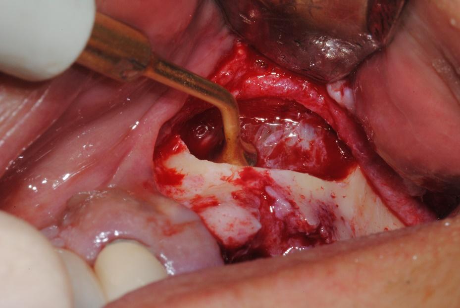 Пьезохирургические аппараты: инновации на службе стоматолога