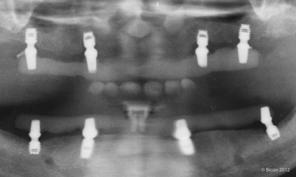 Рентгенограмма после установки протеза.