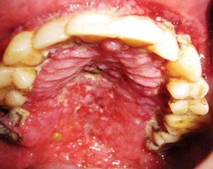 Локальный лейшманиоз слизистой оболочки полости рта - необычная клиника и патогенез