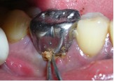 Вертикальный перелом зуба thumbnail