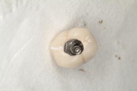 Непосредственная замена сломанного имплантата и смежного зуба: клинический случай