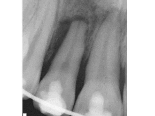 Выживаемость верхнего резца у подростка через 10 лет после отсроченной реплантации