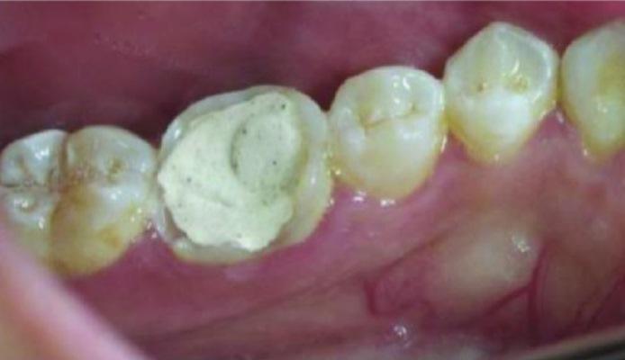 Эндокоронка - альтернатива лечения эндодонтически пораженных зубов