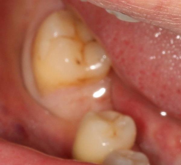 Имплантация в область 4.6 зуба