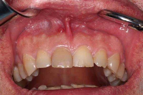 Одномоментная имплантация с немедленной нагрузкой в область 11 зуба