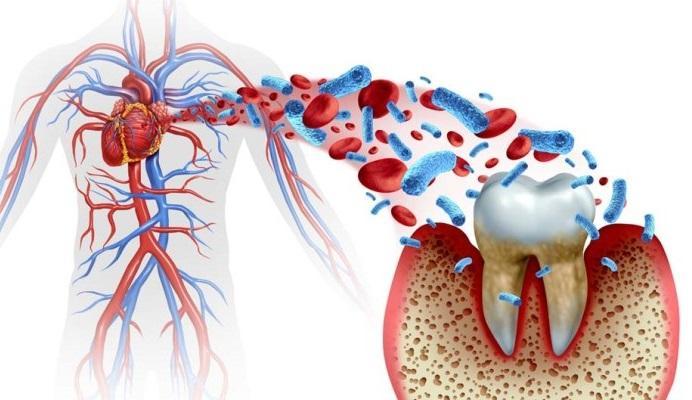 Заболевания сердца и недостаточная санация полости рта