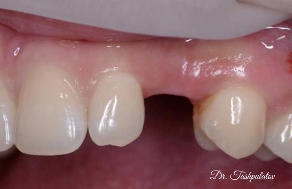 Имплантация в область 23 зуба