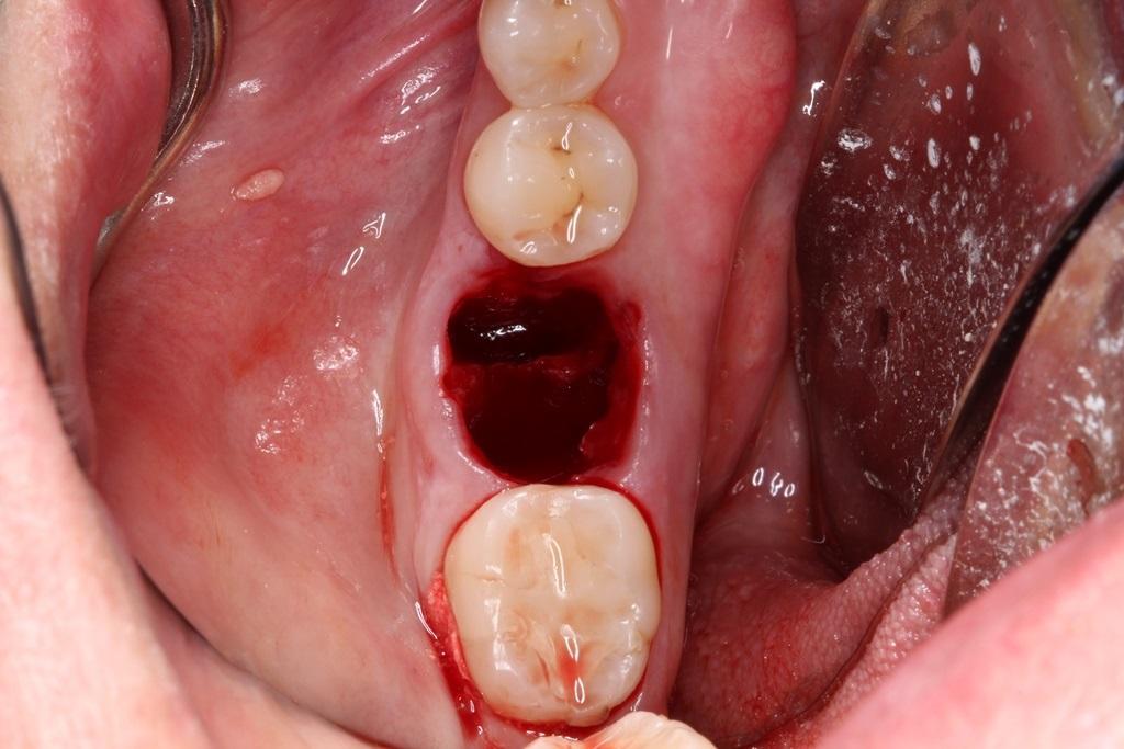 удаление зуба, аугментация, реконструкция лунки зуба 
