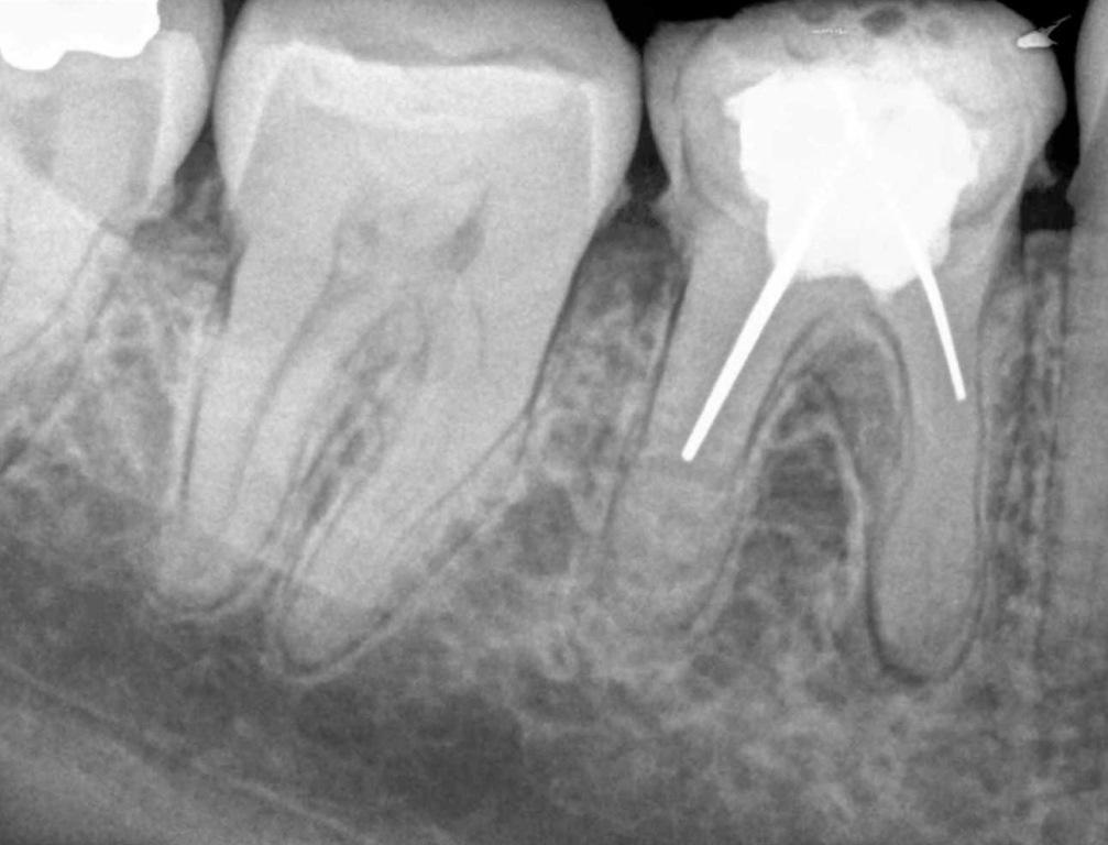 Временное пломбирование корневых. Запломбированные каналы 46 зуб снимок. Прицельный рентген зуба 1.2.