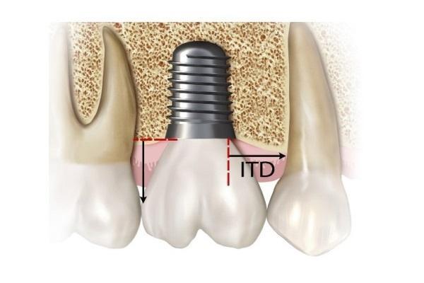 Влияние расстояния от имплантата до зуба на риск развития проксимальных кариозных поражений