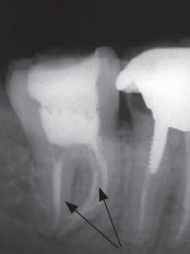 При лечении сломалась игла зуба что может быть