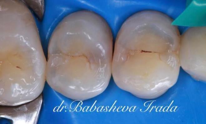 Восстановление апроксимальных поверхностей и изменение анатомии контакта 1.4 зуба