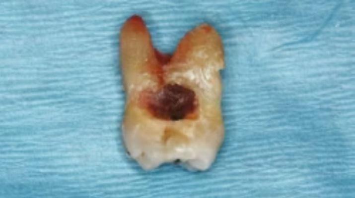 Леденцы без сахара могут стать причиной проблем с зубами