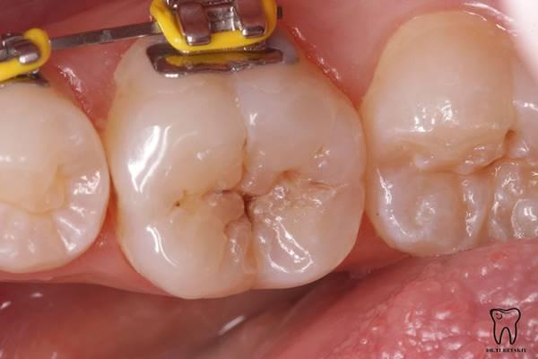 Штамп техника восстановления анатомии зуба