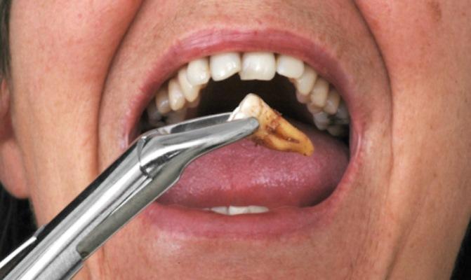 Удаление зуба – показания или вред здоровью?